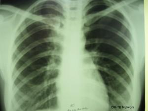 When x-rays show complicated and massive fractures, all you want is an orthopod but in a rural hospital, sometimes a girl's got to go it alone.
